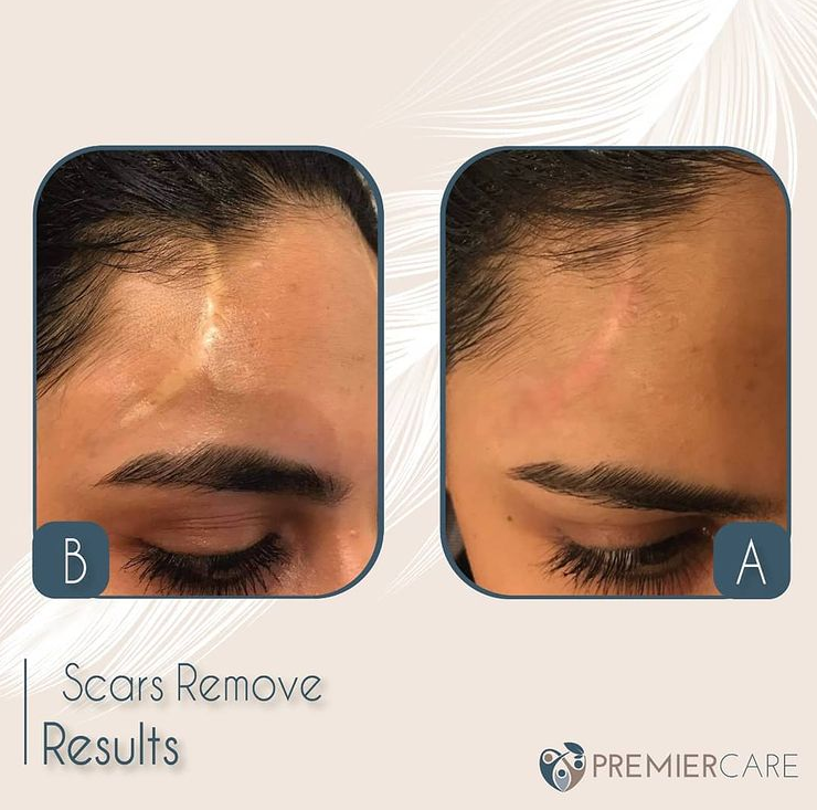 SCARS REMOVE